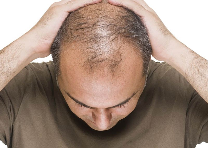 جلوگیری از ریزش مو